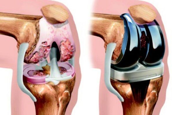 Antes y después de endoprotéticos de la articulación de la rodilla con artrosis