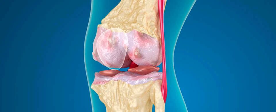 artrosis de la articulación de la rodilla