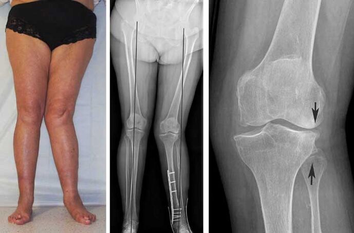 artrosis avanzada de la articulación de la rodilla