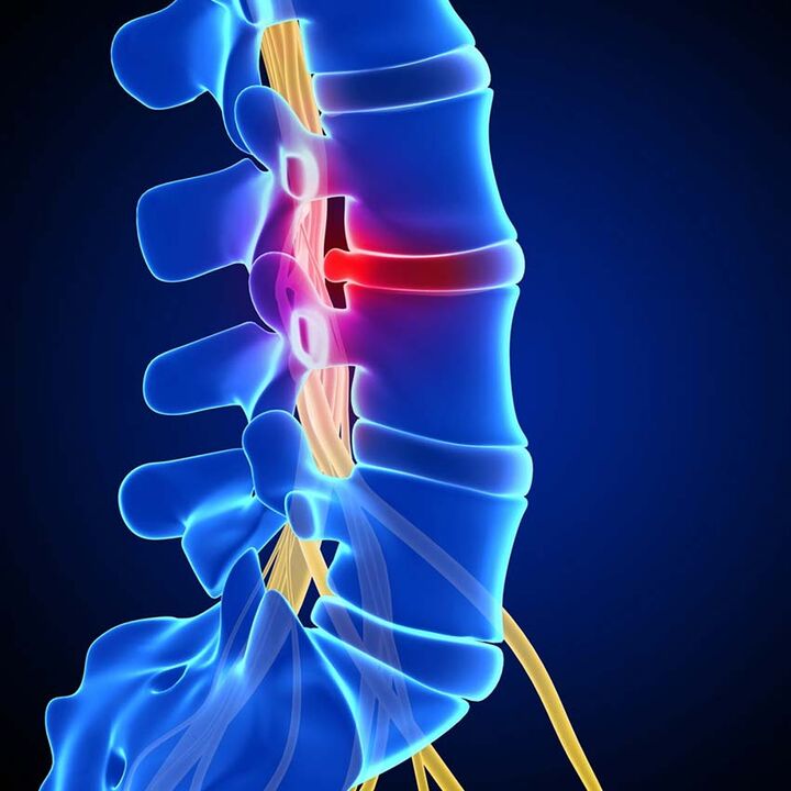 Protuberancia del disco intervertebral en el canal espinal como resultado de la osteocondrosis de la columna lumbar