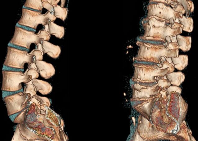 Osteocondrosis de la columna vertebral en una tomografía computarizada